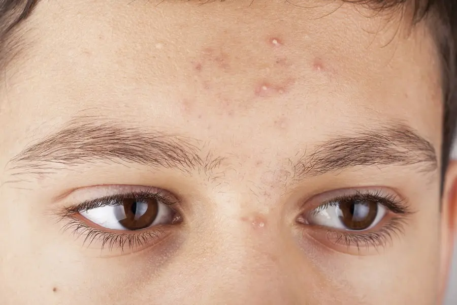 Tips voor scheren met acne